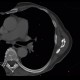 Carcinomatous lymphangoitis, lymphangoitis carcinosa, osteolysis of shoulder blade: CT - Computed tomography